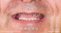بازسازی کامل دندانهای فک بالا و دندانهای عقبی فک پایین با ایمپلنت