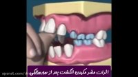مضرات مکیدن انگشت بعد از سه سالگی | دکتر ندا هادی جراح و دندانپزشک زیبایی