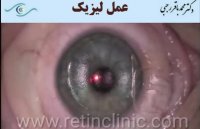 فیلم عمل لیزیک