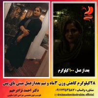 28 کیلوگرم کاهش وزن 3 ماه و نیم بعد از عمل مینی بای پس
