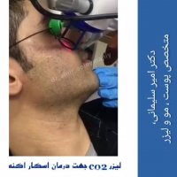 فیلم واقعی رفع اسکار آکنه با لیزر co2