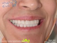 بازسازی دندانها با ایمپلنت و لامینیت سرامیکی