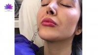 تزریق ژل لب در کلینیک ارکیده