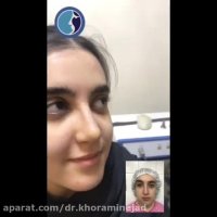 فیلم باور نکردنی قبل و بعد جراحی بینی استخوانی در دختر خانم جوان
