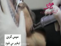 ویدیو کربن پیل با لیزر کیو سوییچ