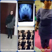 درمان دررفتگی مادرزادی مفصل هیپ