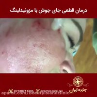 نمونه کاری از مزونیدلینگ -کلینیک جزیره زیبایی