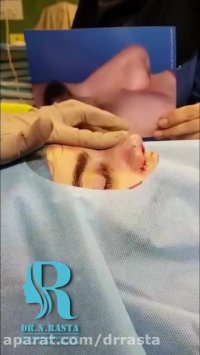 فیلم عمل بینی در زنان