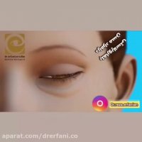 فیلم جراحی پلک (بلفاروپلاستی)