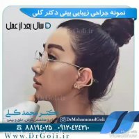نمونه جراحی زیبایی بینی