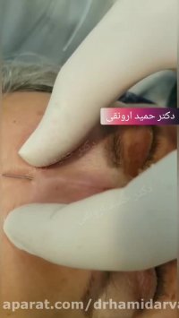 ♦ویدیویی از رفع خط اخم با فیلر هیالورونیک اسید♦