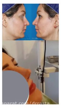 برداشتن گچ بینی بعد از عمل توسط دکتر نسرین راستا