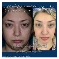 لیفت اندوسکوپی پیشانی و بلفاروپلاستی فوقانی