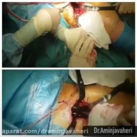 عملیه استبدال مفصل الحوض