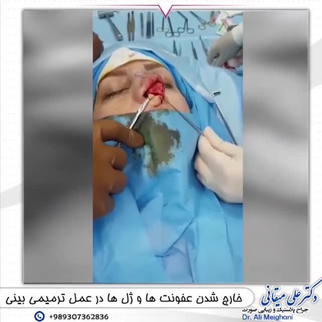 فیلم عمل ترمیمی بینی