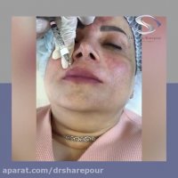 فیلم واقعی تزریق فیلر لب و بلوک عصبی