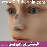 جراحی انحراف بینی
