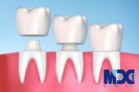 انواع روکش دندان