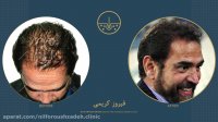 فیروز کریمی قبل و بعد از کاشت مو در کلینیک دکتر نیلفروش زاده