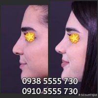 نمونه قبل و بعد عمل بینی