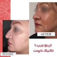 فیلم تزریق چربی به روش نانوفت دکتر فرشته جلالپور