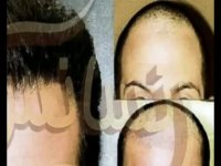 کاشت مو به روش SUT مرکز مو رنسانس