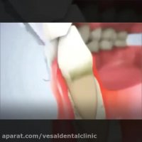 فیلم جرمگیری دندان