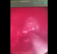 جراحی اندوسکوپی تومور هیپوفیز از طریق بینی