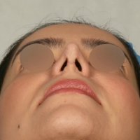 فیلم عمل ترمیم بینی