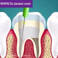 عصب كشی دندان