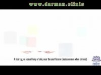 شقاق مقعدی یا فیشر - درمان کلینیک