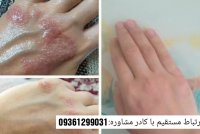 روشی سریع و قطعی برای درمان بیماری پسوریازیس