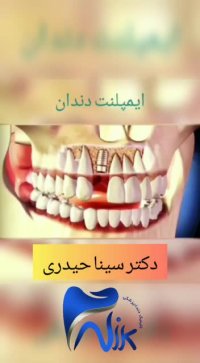 فیلم ایمپلنت دندان
