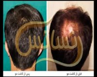 کلینیک کاشت مو رنسانس