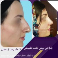 نمونه جراحی قوز بینی