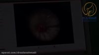 اصلاح جز داخل حنجره این کلافه عروقی به کمک لنز و لیزر KTP