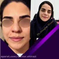 قبل و بعد از عمل بینی را حتما بینید