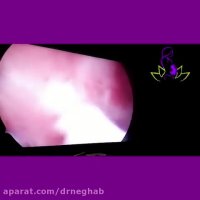 هیستروسکوپی و برداشتن پولیپ رحم توسط دکتر نصرت نقاب