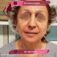 فیلم واقعی لیفت صورت با نخ