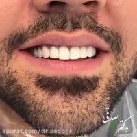 تعویض روکش چهار دندان قدامی و کامپوزیت ونیر سایر دندانها برای اصلاح