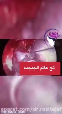 تح عظام الجمجمه