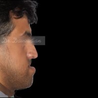 ارتودنسی همراه جراحی فک | دکتر داودیان