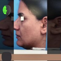 جراحی بینی با پوست نازک در پایین و ضخیم در میانه | دکتر باستانی نژاد