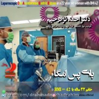 مینی بای پس در خانم 22 ساله