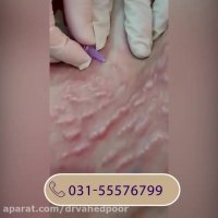 فیلم کربوکسی تراپی شکم برای از بین بردن ترک های شکم