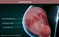 آمنیوسنتز روشی جهت تشخیص ناهنجاری قبل تولد