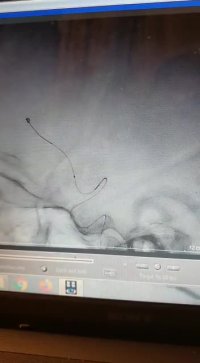 کویل گذاری داخل آنوریسم مغزی