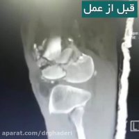 جراحی شکستگی شدید استخوانی