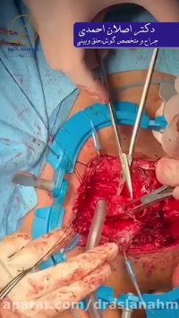 بازسازی راه هوایی و رزکسیون تنگی تراشه