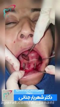 پروتز متکی بر ایمپلنت